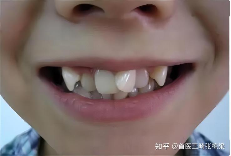 杭州深圳儿童地包天最佳矫正年龄是多少?别等换牙误了大事