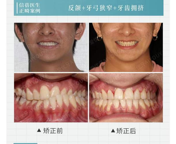 杭州深圳中学生牙齿矫正优惠活动真的靠谱吗?