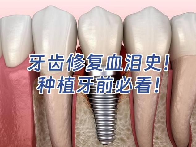 杭州种植牙失败了怎么办 修复费用要多少才合理