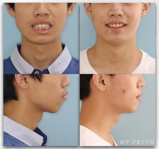 杭州呼和浩特牙齿矫正靠不靠谱?效果真实揭秘