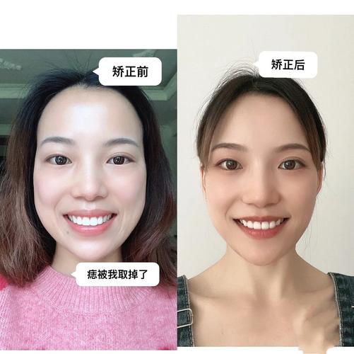 杭州成年人牙齿矫正还来得及吗