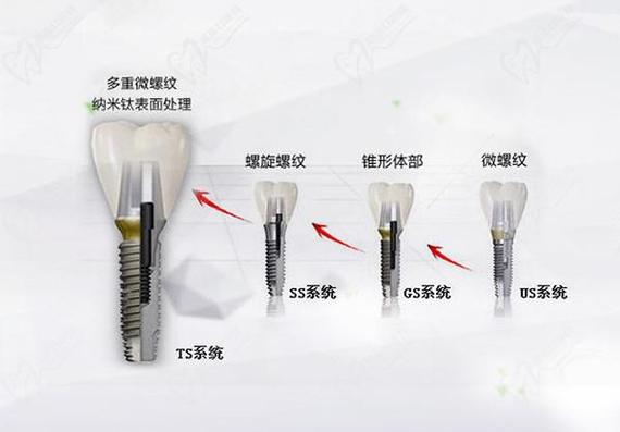 杭州唐山韩系奥齿泰种植牙2026最新费用一览