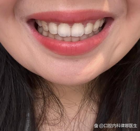 杭州23岁牙不齐还能整吗?正畸黄金期过了没