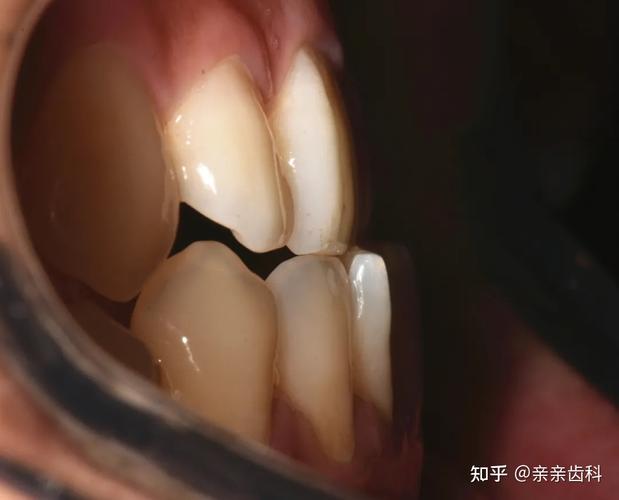 杭州宿迁牙齿矫正大概要花多少钱?本地人帮你算笔账