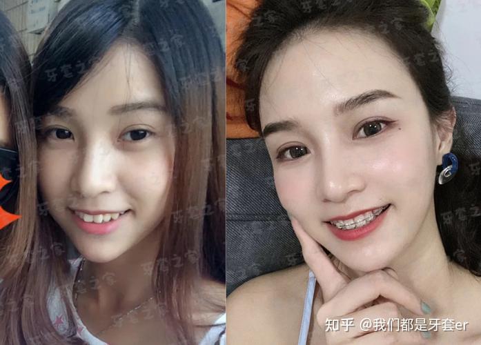 杭州43岁矫正深覆合牙齿要多少钱？从检查到摘牙套费用全掰扯清楚