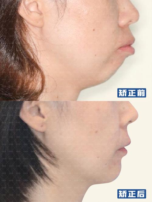杭州矫正牙齿能改善下巴后缩吗？3个关键问题正畸医生一次说清