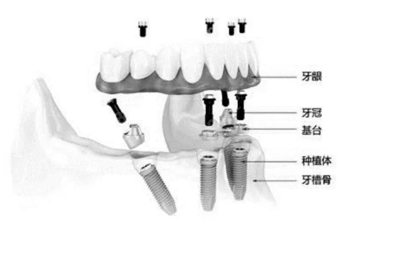 杭州半口种牙费用不固定 一颗大概多少钱
