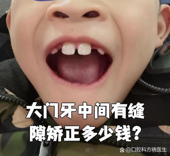 杭州保定矫正牙齿费用一览:一般多少钱?价格明细来了