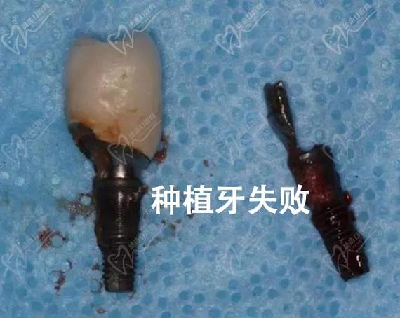 杭州深圳福田单颗种植牙哪家医院靠谱？看这里就对了！