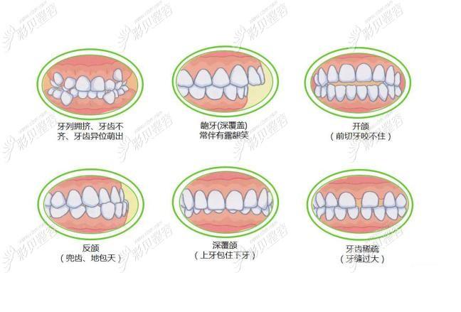杭州南阳牙齿矫正多少钱?2026最新价格大公开
