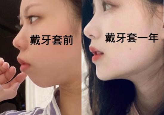 杭州郴州做牙齿矫正哪家好?看完这篇不踩坑