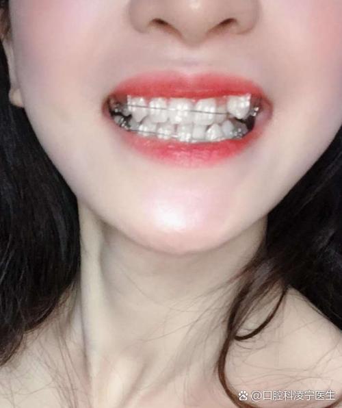 35岁可以做隐形牙齿矫正吗_隐形牙齿矫正做可以维持多久_隐形矫正牙齿期间可以怀孕吗