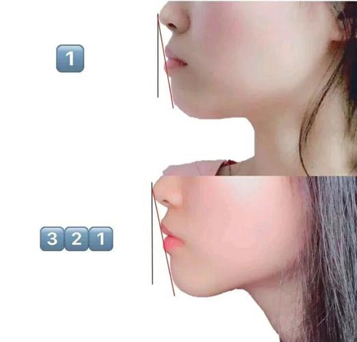 杭州34岁做龅牙矫正还来得及吗？我的真实感受