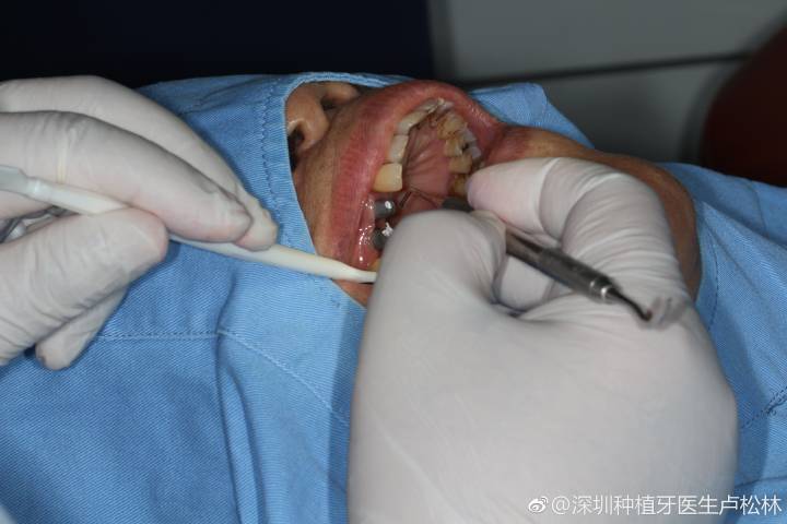 杭州80岁还能种牙吗？医生说只要满足这个条件就能做