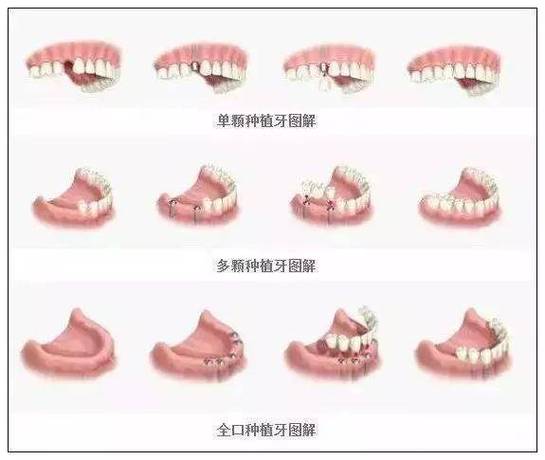 杭州半口种植牙全过程要多久？疼不疼？一步步讲清楚