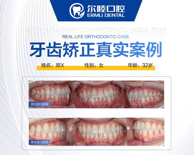 杭州成人矫正牙齿咬合疼不疼？效果和费用全解析