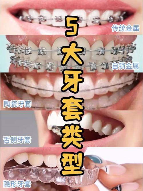 牙齿矫正器种类_牙齿矫正器种有几种_12岁牙齿矫正器有哪几种