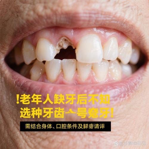 一定要种牙吗知乎_必须种牙吗_70岁有必要种牙吗