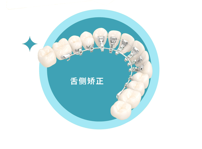 杭州成年人牙齿舌侧正畸到底值不值？看完这几点就懂了