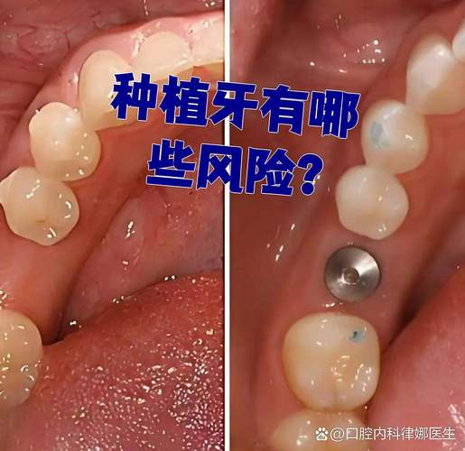 杭州全口种植牙的风险和后遗症有哪些