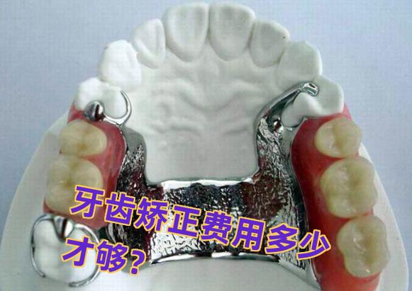 杭州长沙矫正牙齿费用一览：从几千到几万差在哪