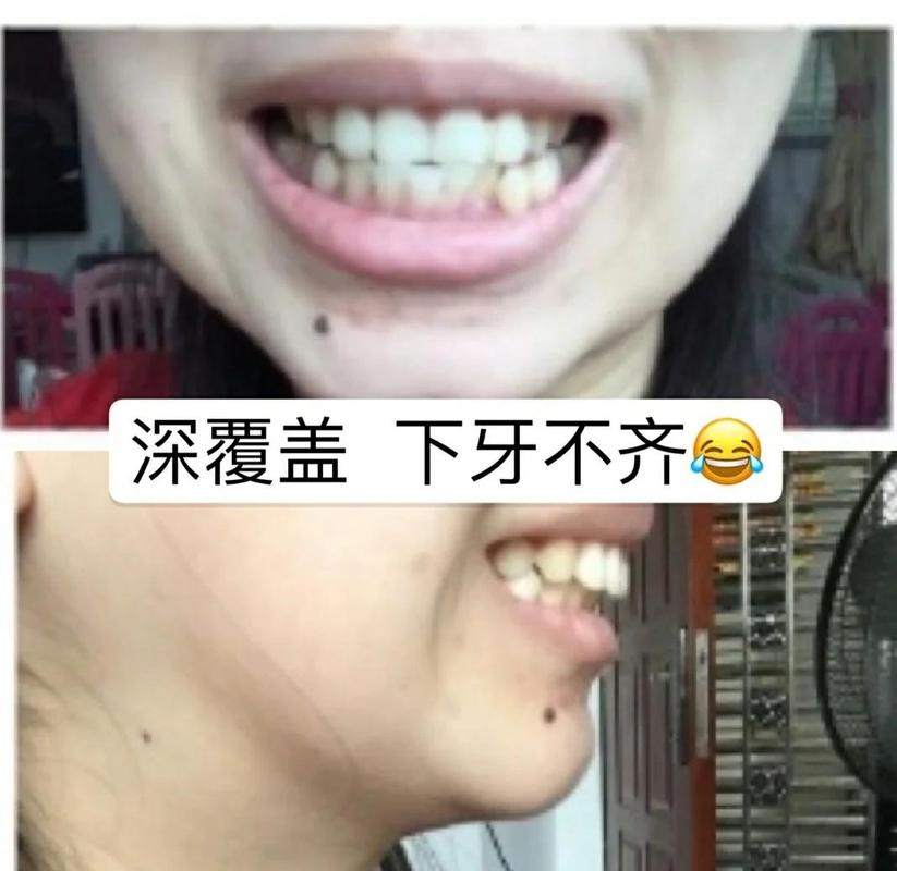 杭州39岁牙齿矫正还有用吗 真实效果看这里