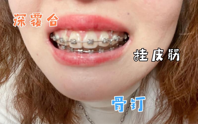杭州深圳深覆合正畸去哪家好？牙科推荐避坑指南